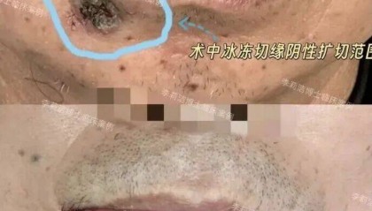 57岁男子把唇上肿瘤当痘痘挤了8年，医生提醒