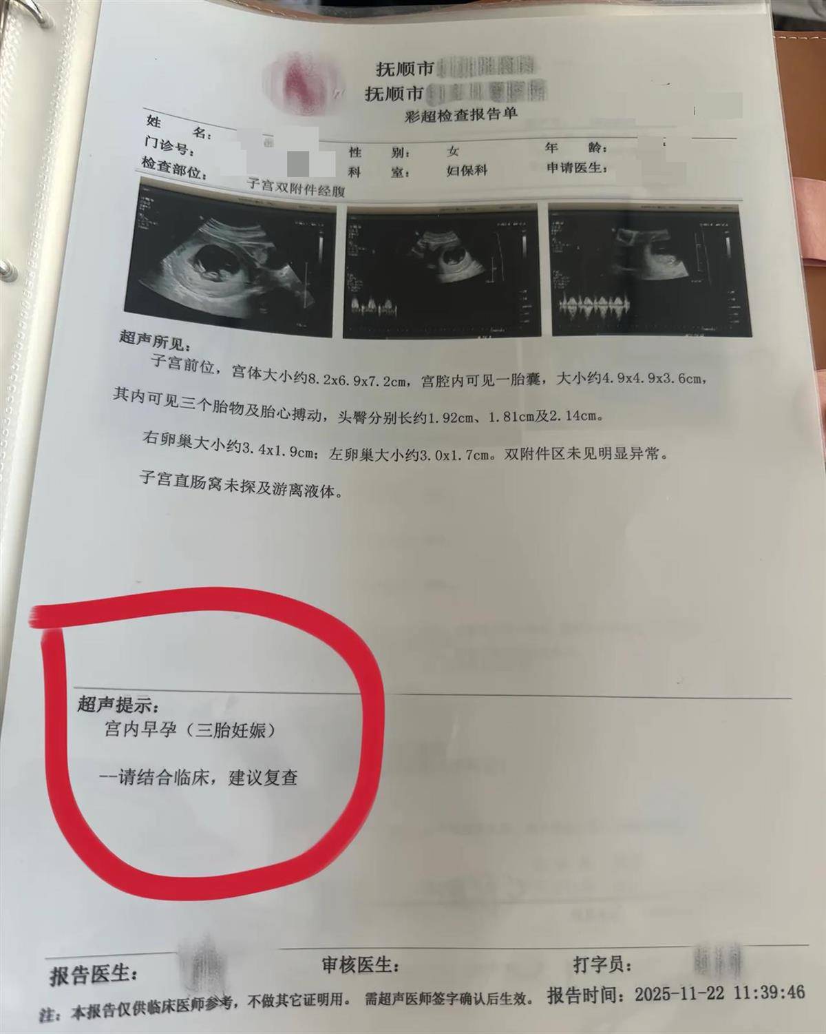 辽宁一孕妇两个月内从一胎变四胞胎，每次产检发现多出一胎，医生：系同卵四胞胎，概率1300万至1500万分之一