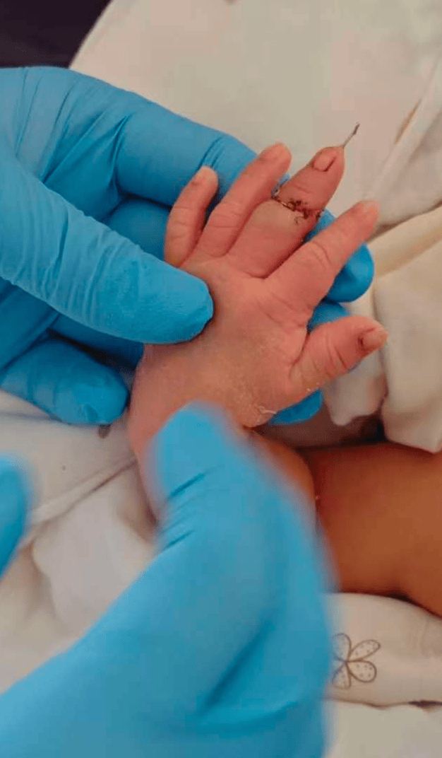 新生儿剪脐带时疑被助产士剪断手指 家属：已申请医疗事故鉴定